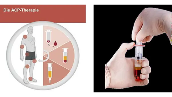 ACP-Therapie – Autologes Conditioniertes Plasma